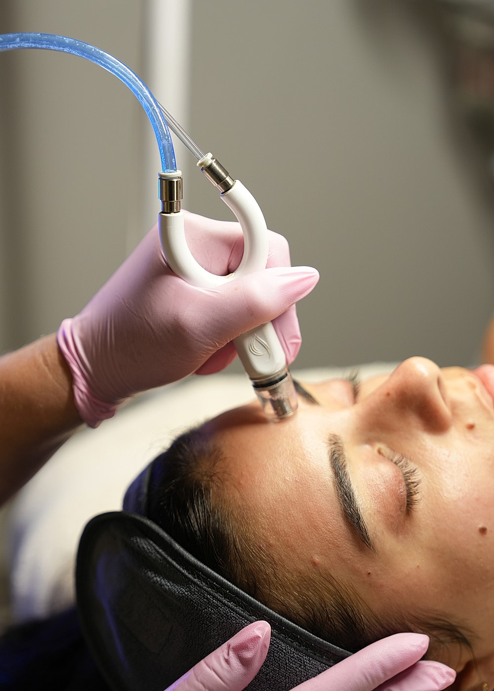 Microneedling treatment in progress on a patient.